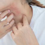 Ropa dermatitis atópica