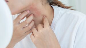 Ropa dermatitis atópica